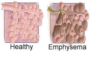 Emphysema-6