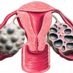 polycystic ovaries